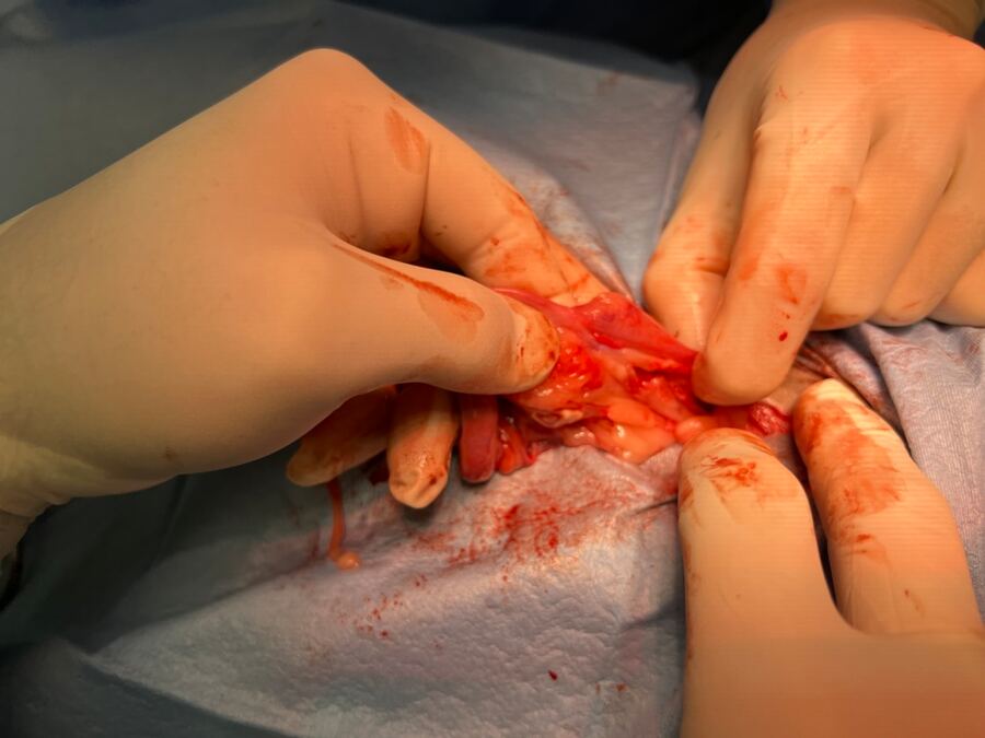 ovarian ligament