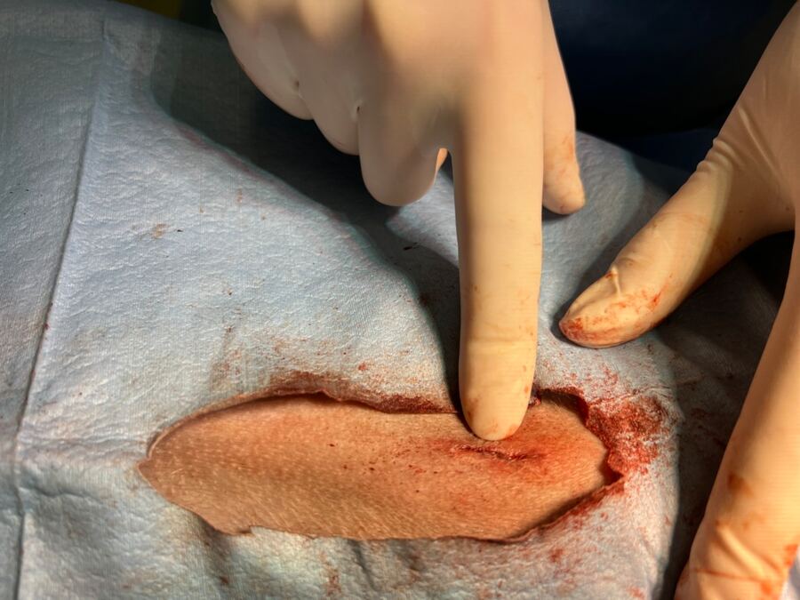 mini wound  sterilisation
